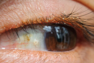 What is blepharitis 1 Blepharitis 2