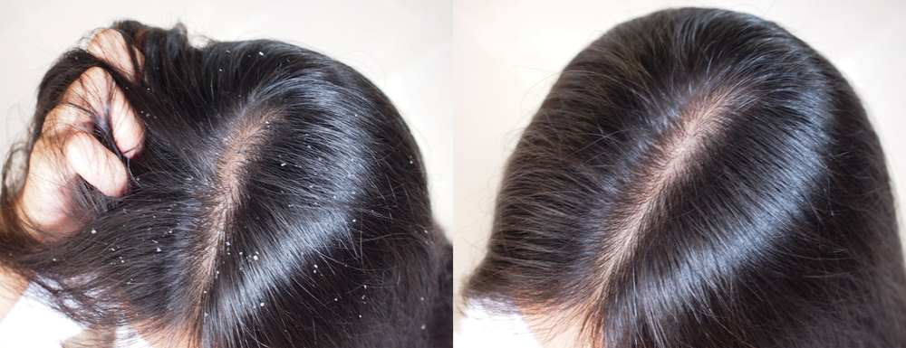 What is dandruff 1 Dandruff