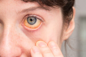 Eye cancer