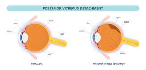 Posterior vitreous detachment