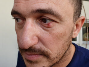 Stye