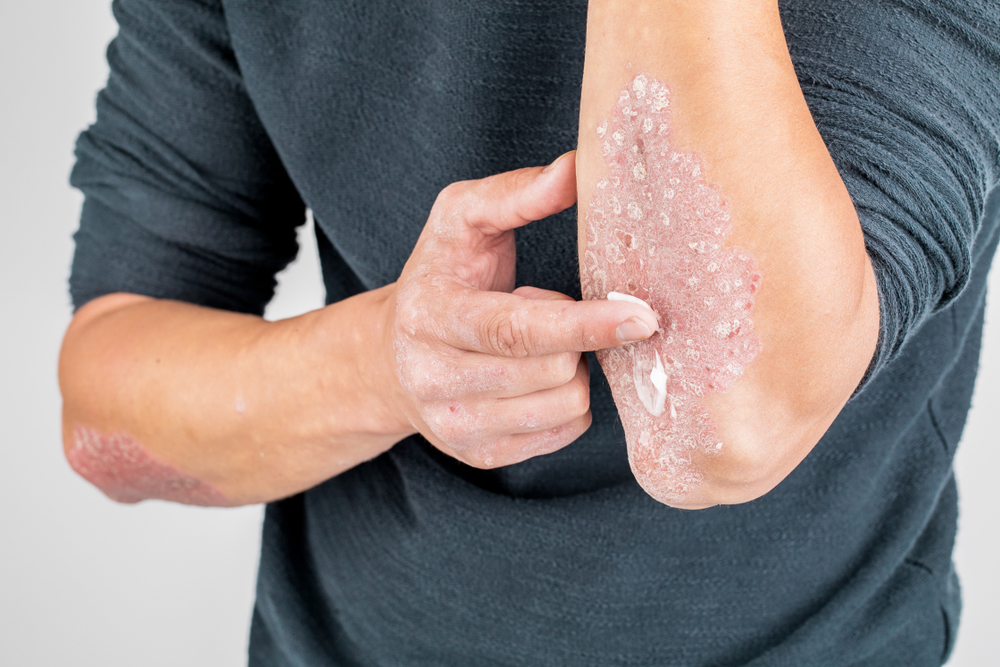 psoriasis
