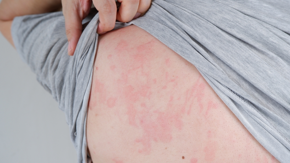 Urticaria 1 Urticaria