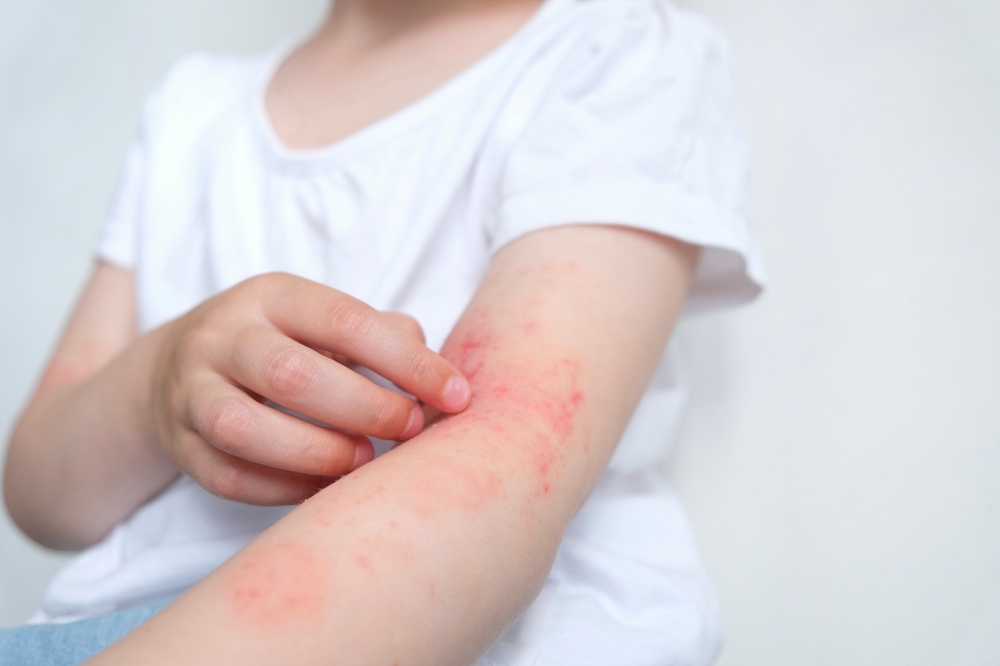 Psoriasis