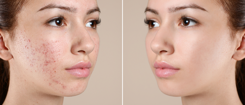 Acne Scar