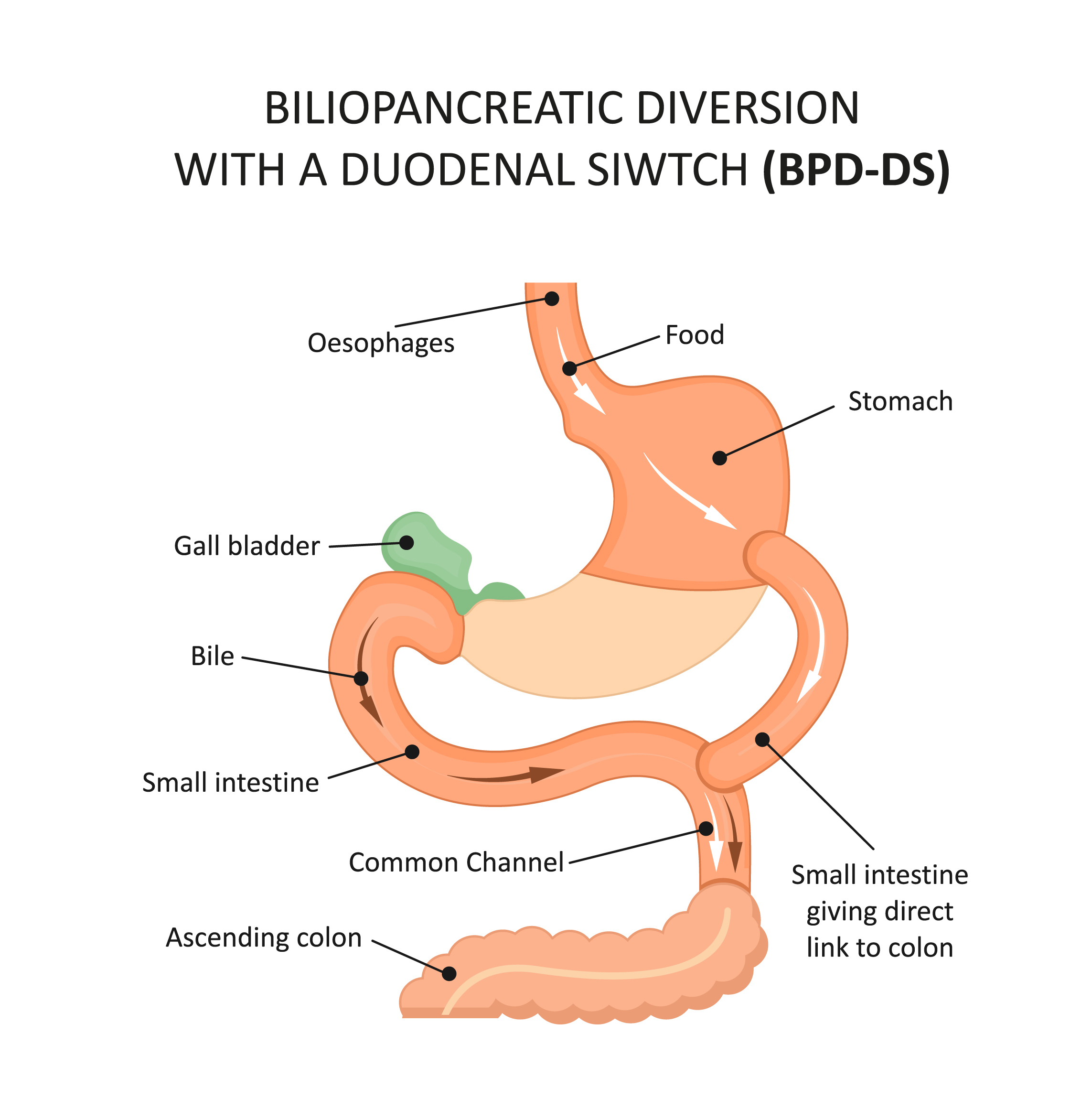 BPD/DS surgery