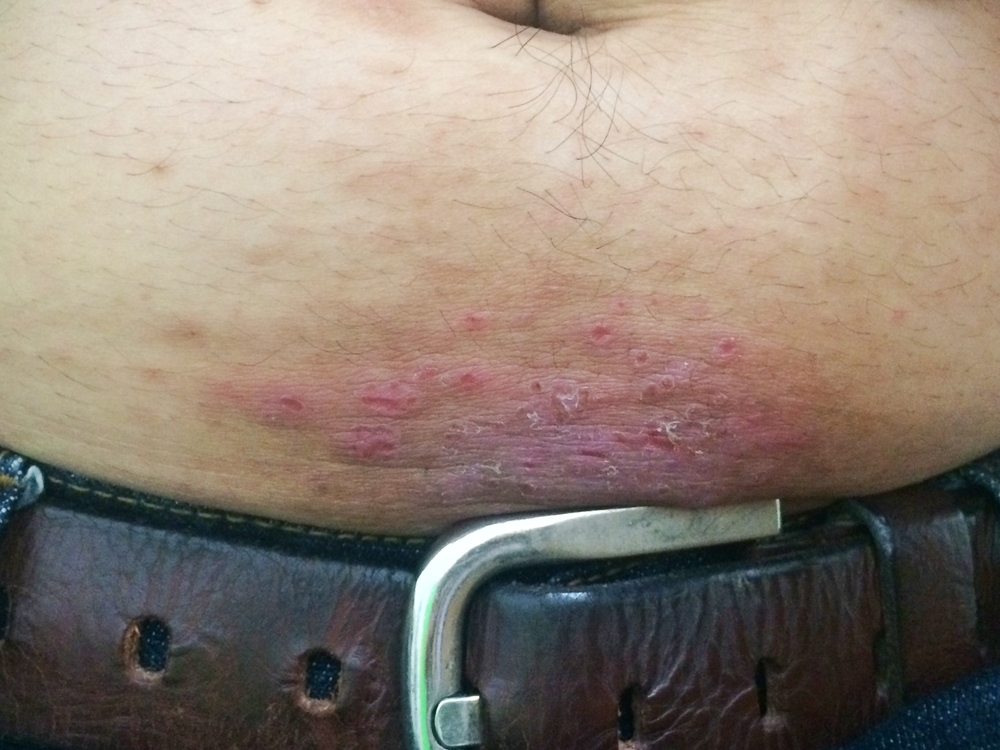 Contact Dermatitis