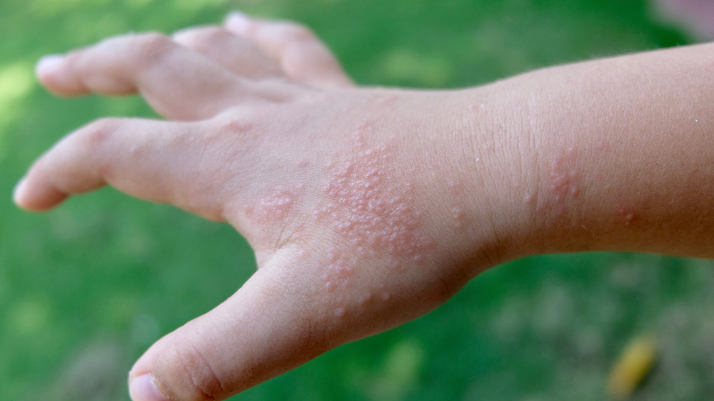 What is dyshidrosis: best treatments for you 1 Dyshidrosis
