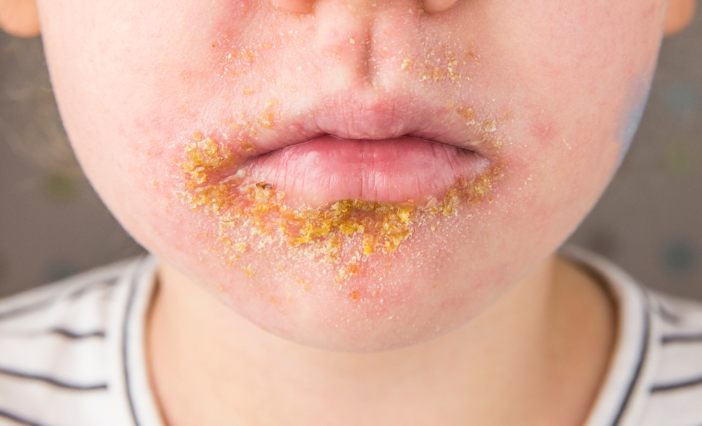 Impetigo 1 Impetigo