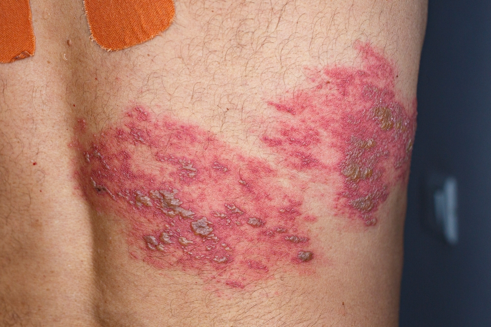 Skin lesions