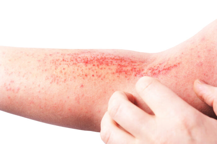 Stasis dermatitis on the lower leg showing skin discoloration, swelling, and redness caused by poor circulation.