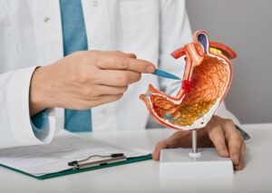 Ulcers 1 Ulcer