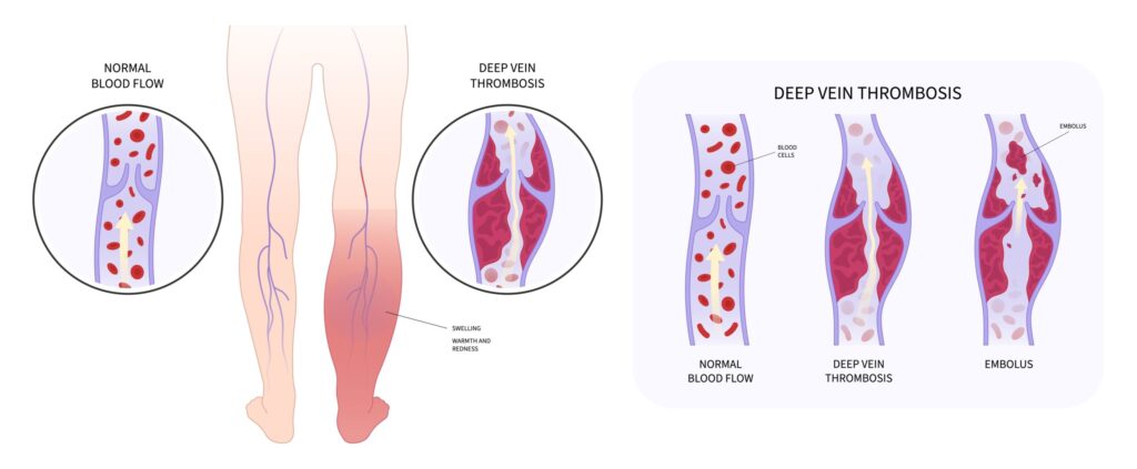 Deep vein thrombosis