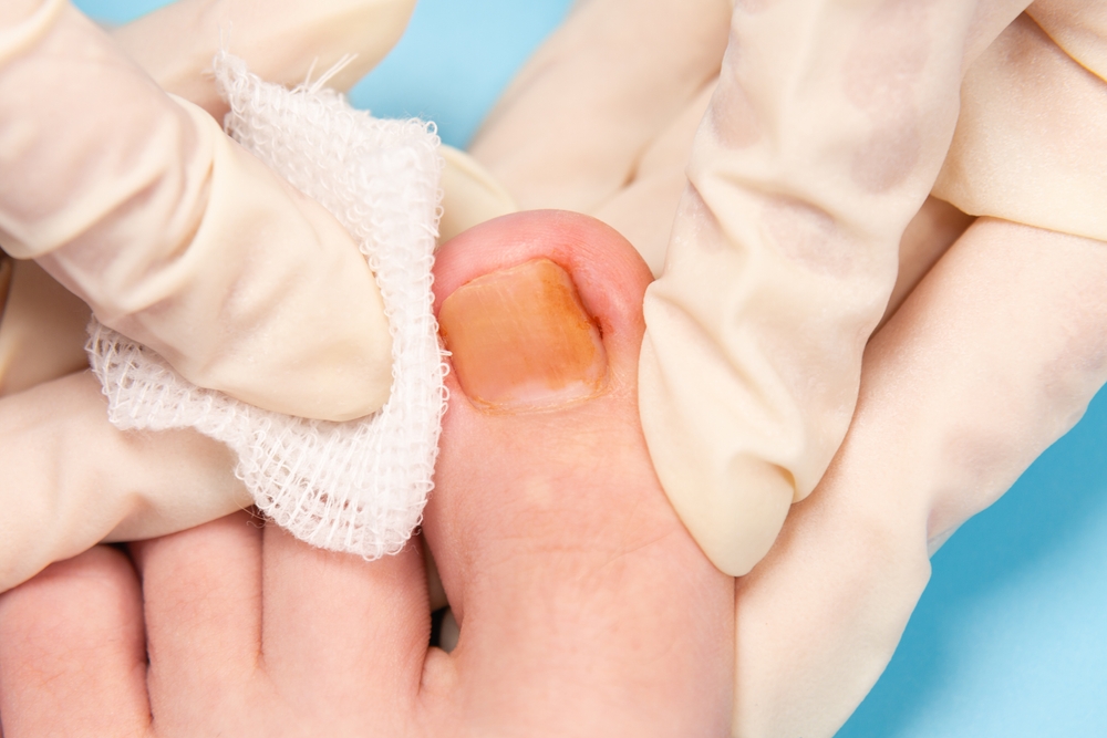 Ingrown toenail 11 12 2023 11 27 04 676