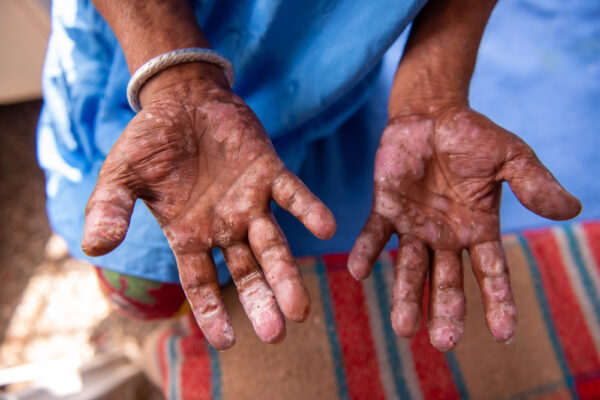 Child displaying a skin reaction on the hands during a medical examination for a Lepromin skin test.