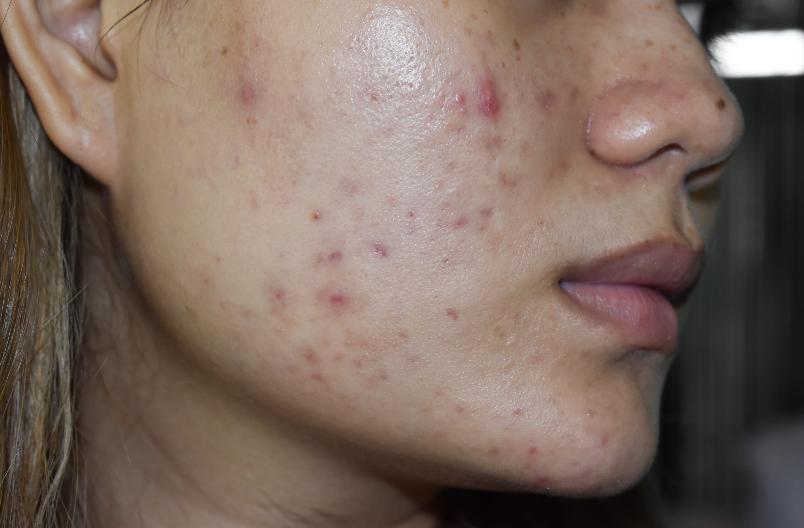 acne scarring treatment