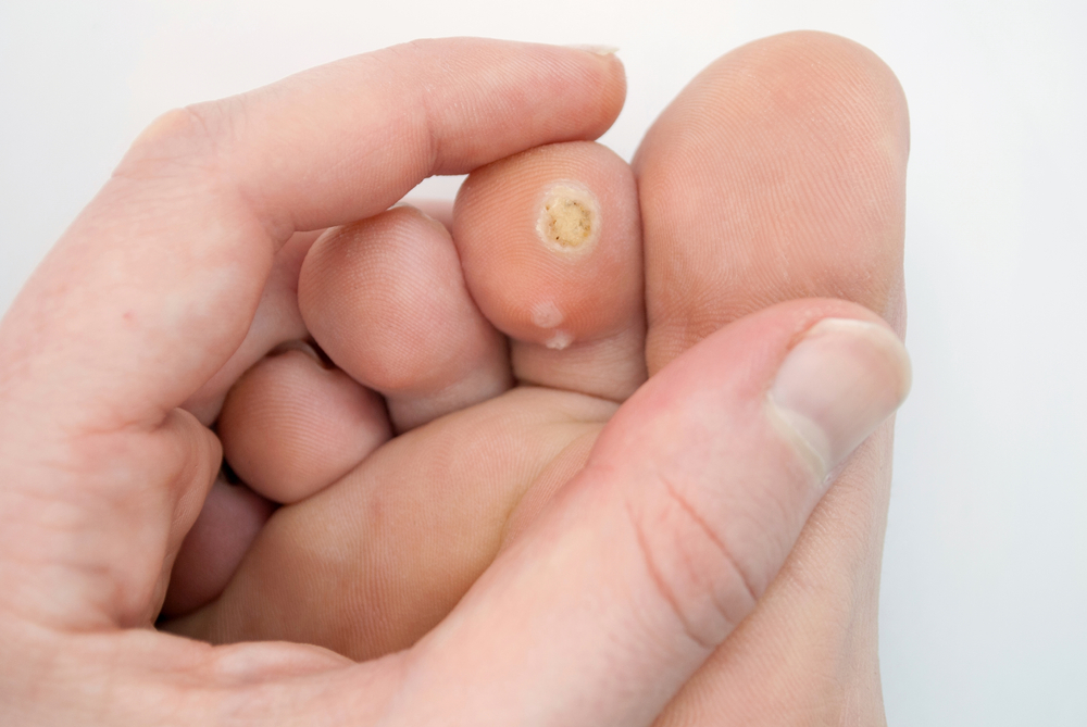 Plantar Warts