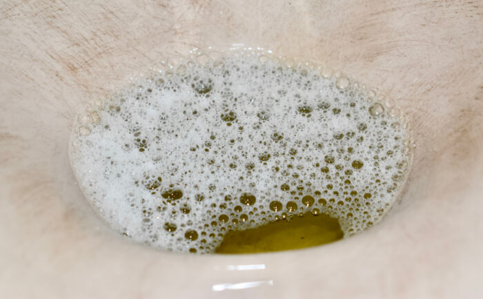 Foamy urine in a toilet bowl illustrating a possible sign of proteinuria and kidney health issues.