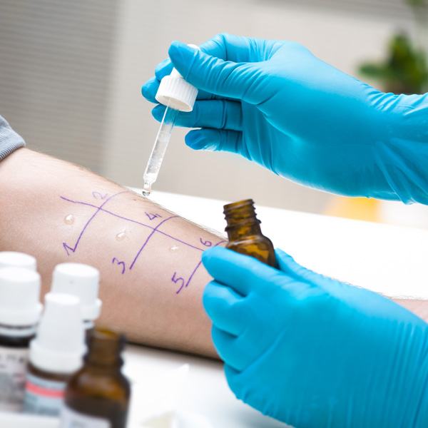 Skin allergy test with multiple drops applied on a patient’s forearm.