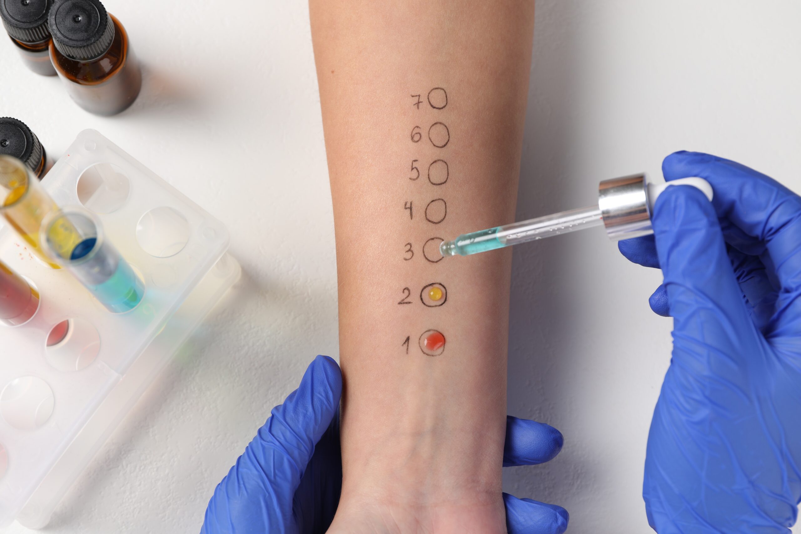 Skin Allergy Test