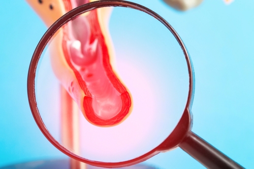 Home remedies for bacterial vaginosis: natural treatments 1 Bacterial vaginosis