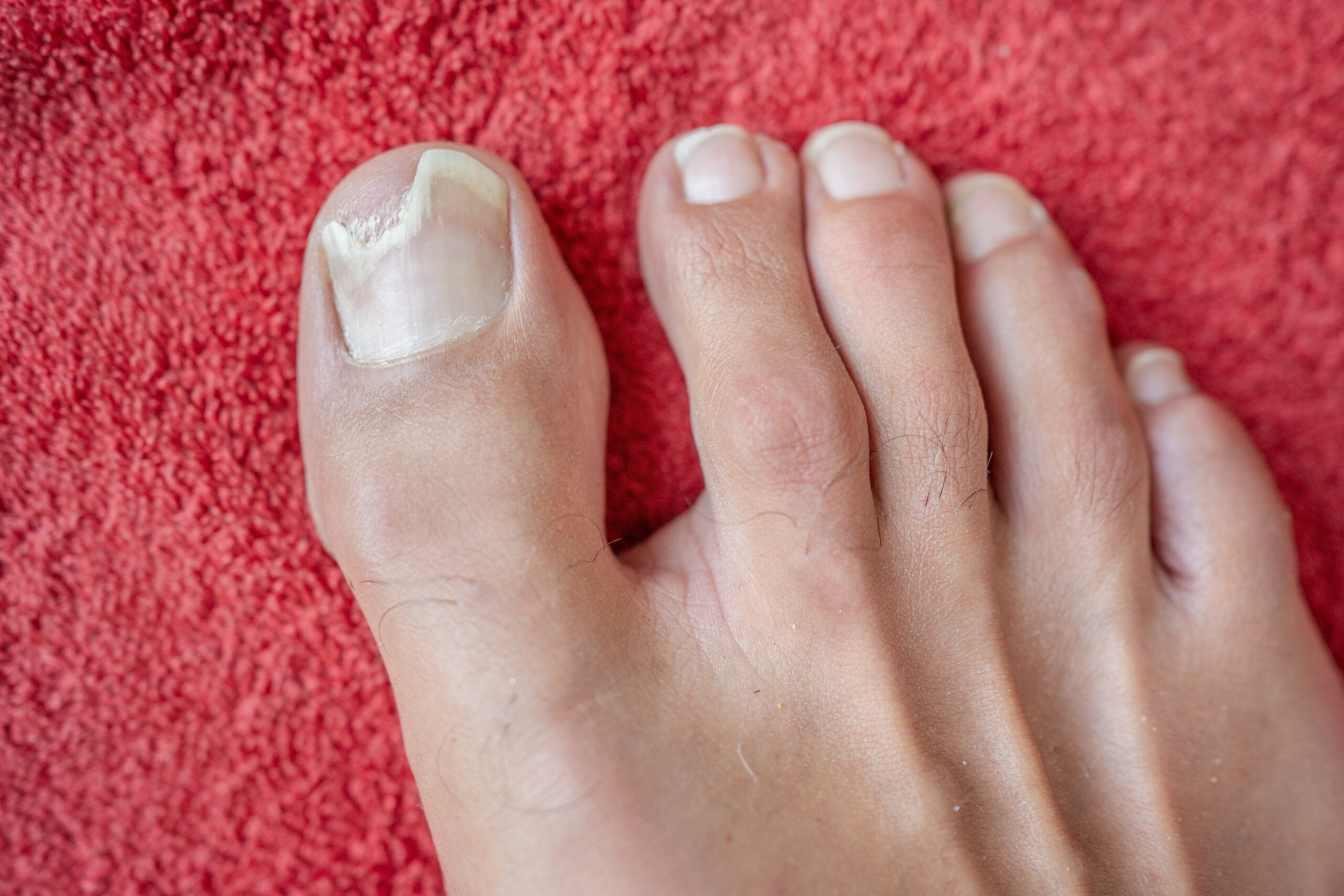 Close-up of a nail disorder showing discoloration and thickening, illustrating when to see a dermatologist vs. a podiatrist.