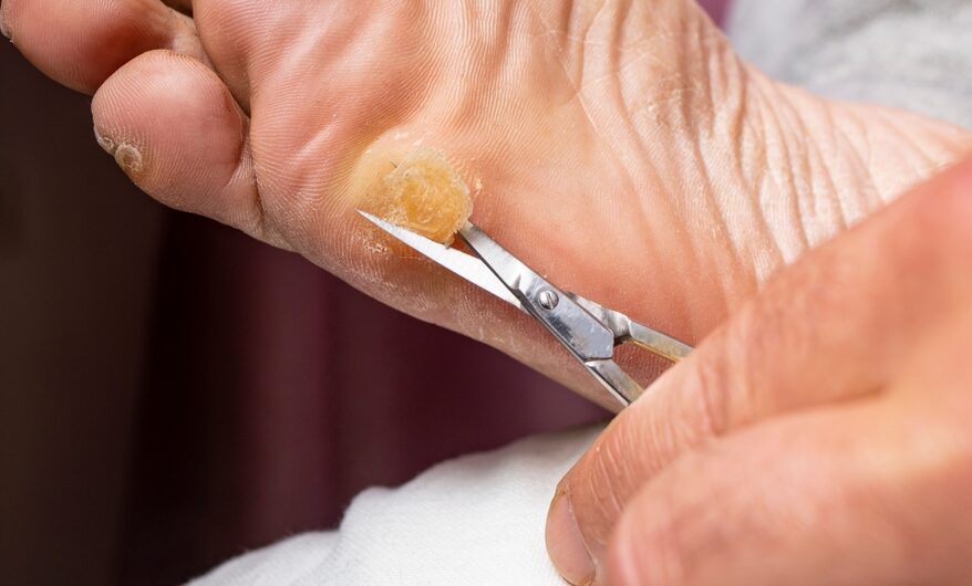 Person receiving professional callus removal treatment on foot at a podiatry clinic