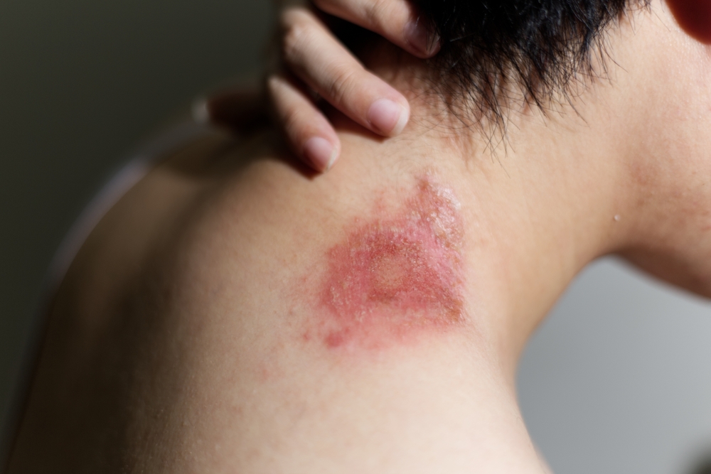 Eczema