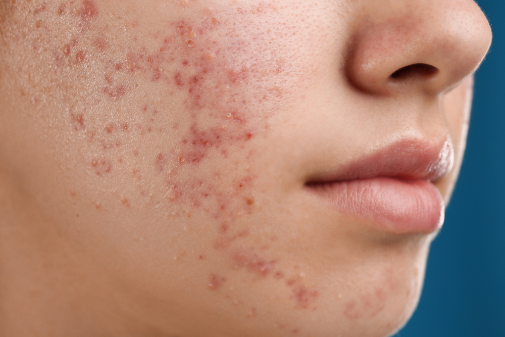 Inflammatory Acne