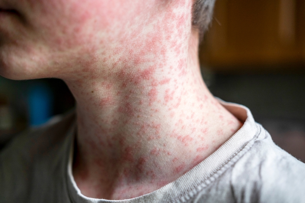 Measles