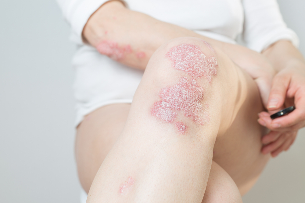 Psoriasis