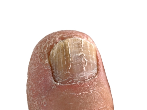 Nail disorders