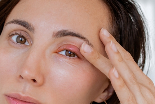 Swollen eyelids