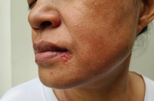 herpes home remedies