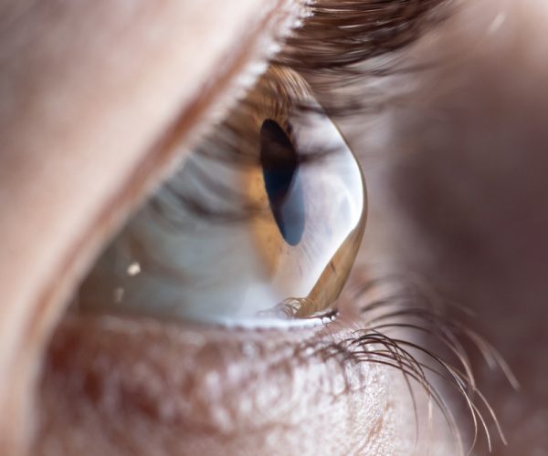 Corneal Transplant