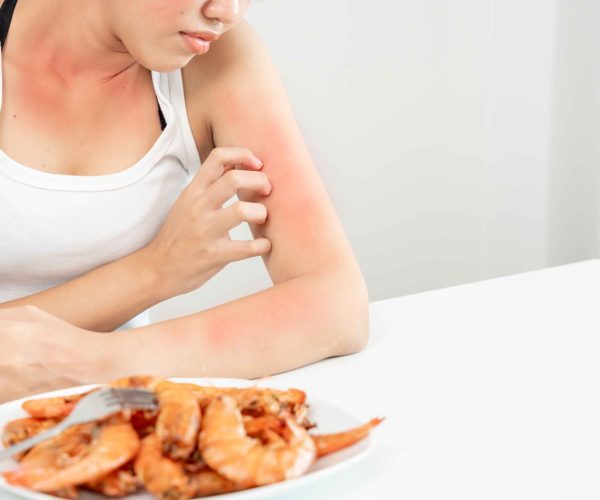 Food-Allergies