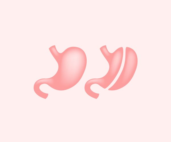 Sleeve Gastrectomy