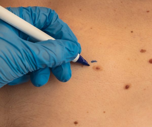 Doctor,In,Medical,Gloves,Paint,Lines,Around,Male,Birthmarks.,Preparing