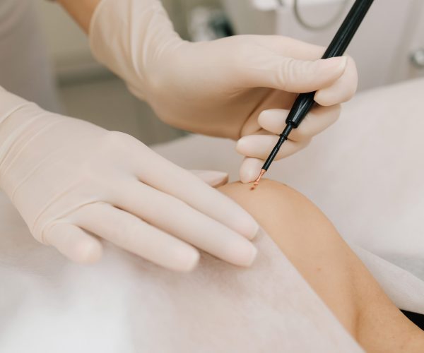 Dermatologist,Performs,Precise,Radio,Wave,Mole,Removal,Using,Radiofrequency,Surgery.