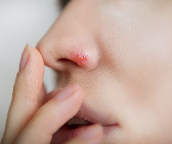 Herpes,On,The,Nose,-,Pretty,Young,Caucasian,Woman,With